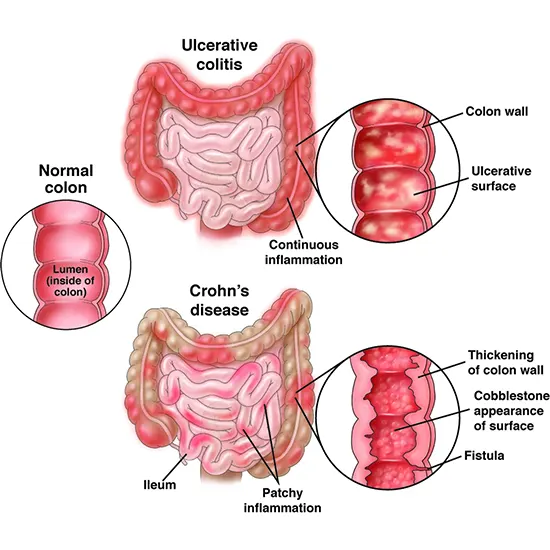 Inflammatory bowel disease (IBD): Causes, Symptoms & Treatment